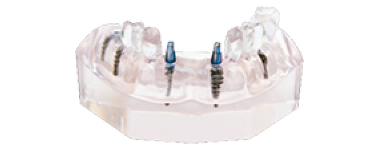 TM-T12 Implant Model